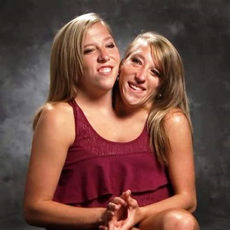 real conjoined twins Search